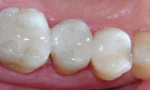 Временная пломба на молочном зубе откололась