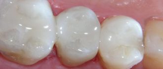 Временная пломба на молочном зубе откололась