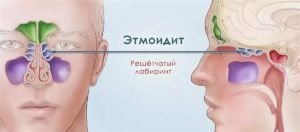 Двухсторонний катаральный гаймороэтмоидит