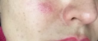 Выпуклые круглые симетричные пятна на щеках