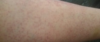 Мелкие пятнышки на ногах