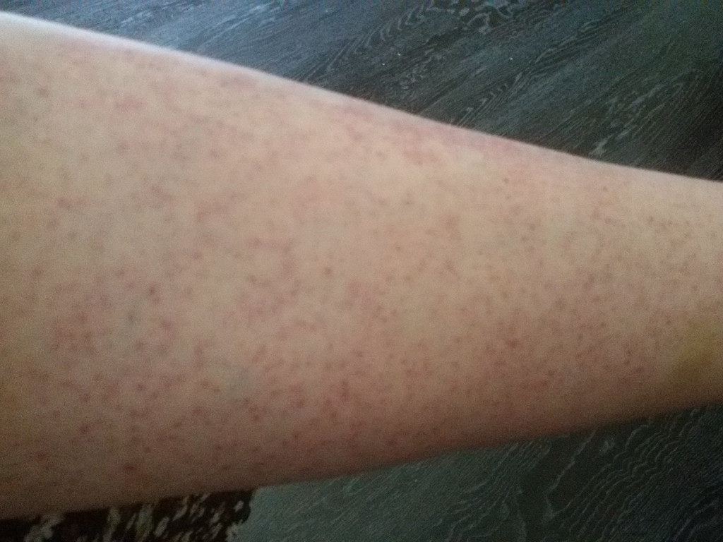 Какие кожные заболевания бывают на ногах фото
