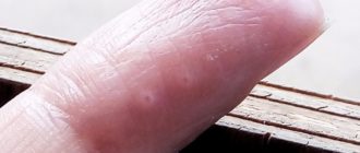 Водные пузыри под кожей