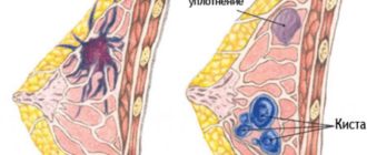 Над грудью уплотнение