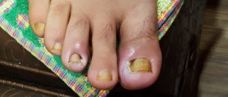 Долгонезаживающая рана на большом пальце ноги