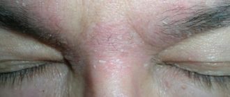 Красная бляшка на лбу у взрослого