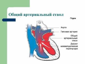Впс у плода: общий артериальный ствол, ДМЖП