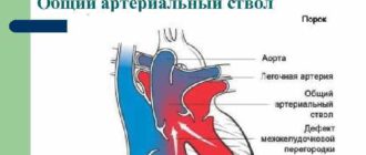 Впс у плода: общий артериальный ствол, ДМЖП