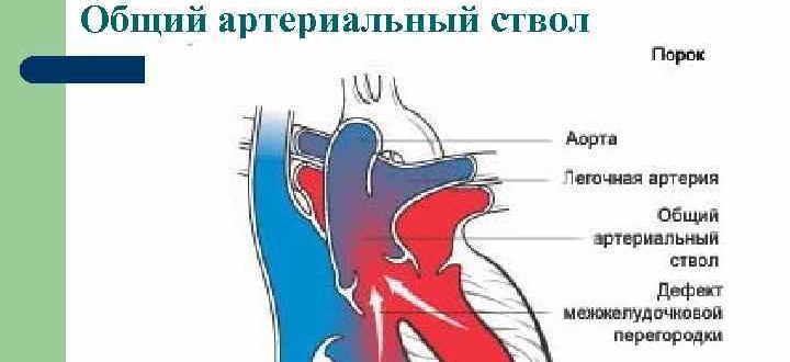 Впс у плода: общий артериальный ствол, ДМЖП