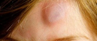 Вскочила шишка