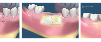 Что то белое и твердое торчит сбоку от удаленного зуба
