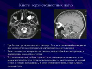 МР-Признаки синусопатии верхнечелюстных пазух и кисты левой верхнечелюстной пазухи