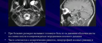 МР-Признаки синусопатии верхнечелюстных пазух и кисты левой верхнечелюстной пазухи
