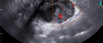 УЗИ малого таза и онкология