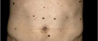 Множественные невусы