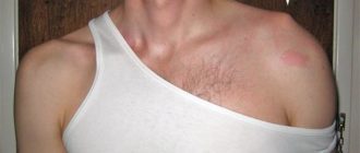 Вылетает ключица