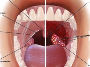 Дискомфорт в горле, образование за миндалиной