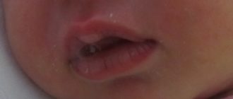 Мозоль на губе