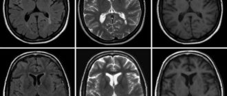 Мрт картина