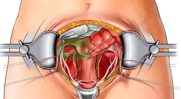 Восстановление организма после удаления матки