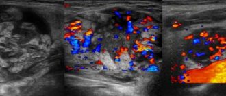 Васкуляризация сосудистой ножки лимфоузла