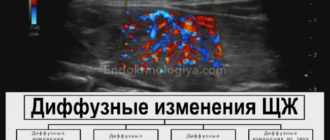 Диффузные изменения щитовидной железы с узлообразованиями