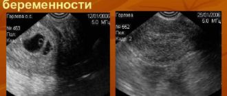 УЗИ после медикаментозного прерывания беременности