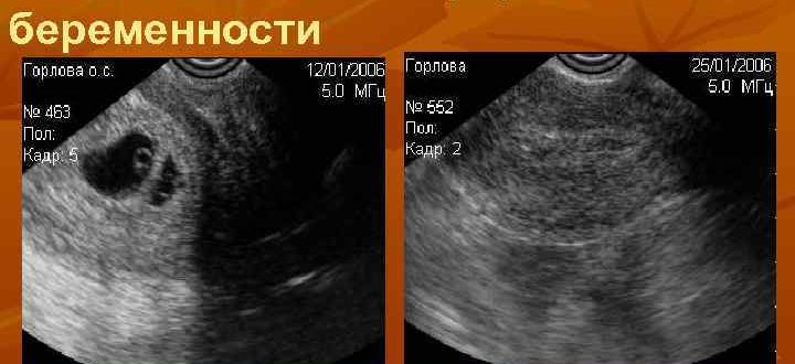 УЗИ после медикаментозного прерывания беременности