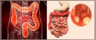 Диета при аденокарциноме сигмовидной кишки
