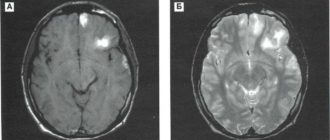 Единичный очаг левой височной доли