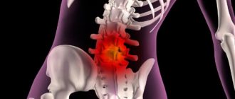 Экструзия L4-5, люмбоишиалгия, радикулопатия l5