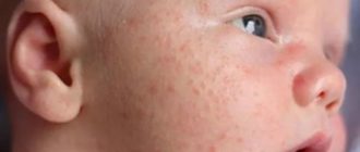 Мелкие прыщики на лице у грудничка