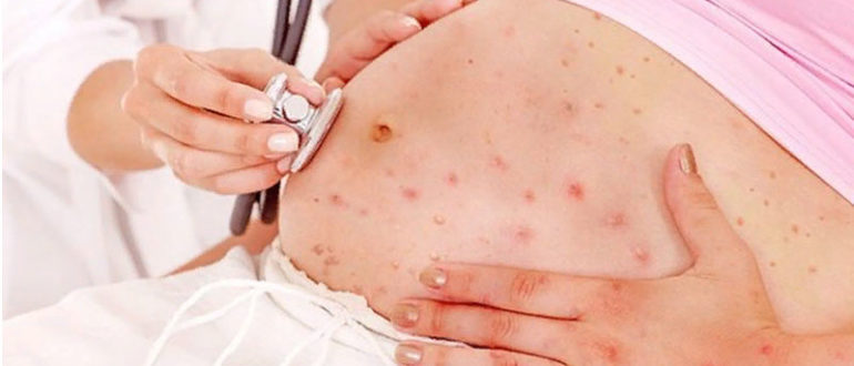 Ветрянка, месячные