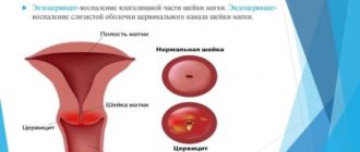 Экзоцервицит консультация