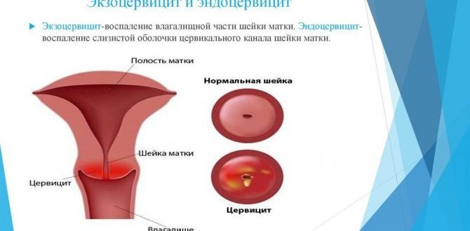 Экзоцервицит консультация