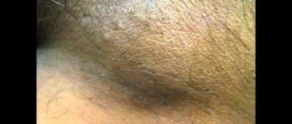 Молочница и воспаление лимфоузла в паху