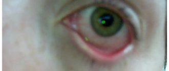 Мутно в глазах после сна