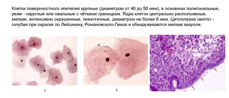 Воспалительный тип мазка, клетки МПЭ