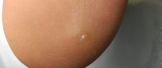 Дырочки на пятке