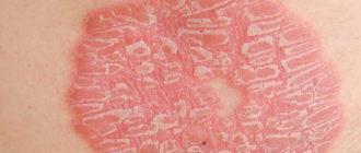 Кожная бляшка без зуда