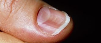 Деформация ногтя