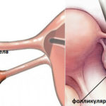 Двустворчатый аортальный клапан