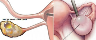 Набухла грудь при кисте жёлтого тела
