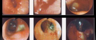 Может ли открыца Постъязвенный рубец луковицы ПОД