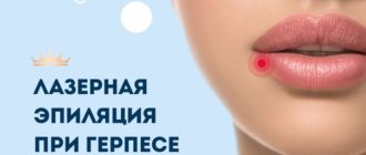 Можно ли лайзерную эпиляцию при Герпесе?