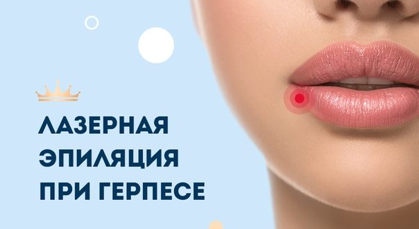 Можно ли лайзерную эпиляцию при Герпесе?