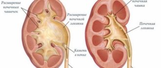 ЧЛС лоханка расширена