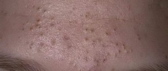 Дыры от черных точек, воспаления, подкожники, фото