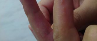 Чешется между пальцами рук при беременности
