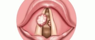 ВПЧ и ротоглотка